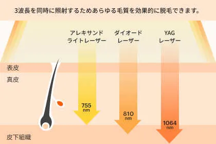 ソプラノチタニウム3レーザー