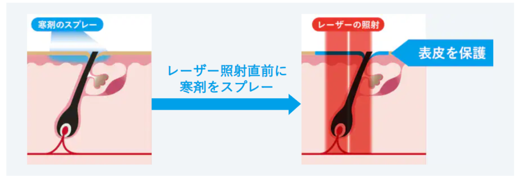 湘南美容クリニックジェントルマックス冷却機能